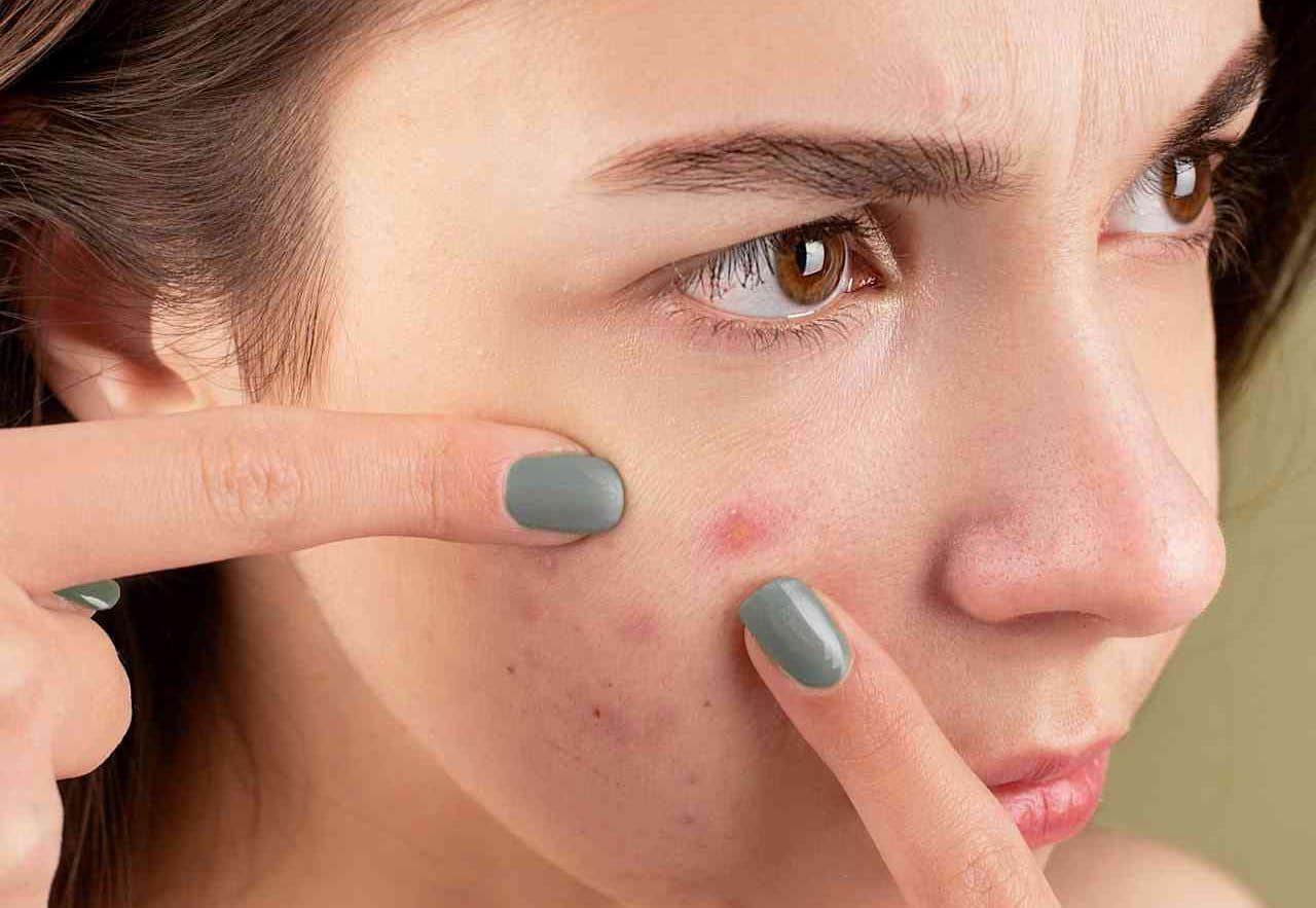 Why Women Get Hormonal Acne?